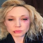Кристина Орбакайте показала следы побоев на лице